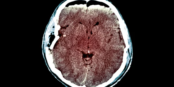 20hs Tbi Superjumbo